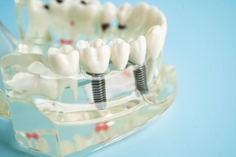 wszczepienie implantu